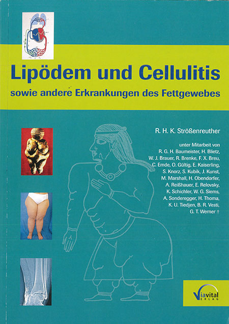 Lipoedem-und-Cellulitis